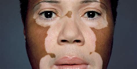 How Vitiligo Affects An Individual Life Psychological Issues Faced By