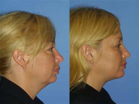 5 Fixes For A Sagging Jawline Gotham Plastic Surgery