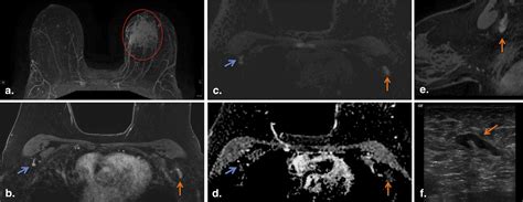 Suspicious Axillary Lymph Nodes Identified On Clinical Breast Mri In