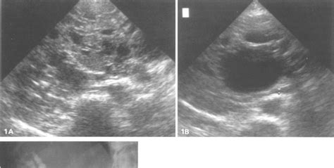 Polycystic Liver Disease With Obstructive Jaundice Treatment With