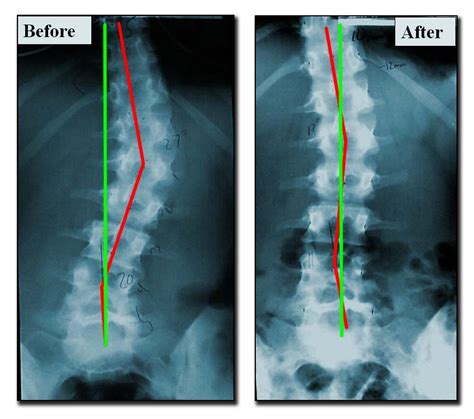 Scoliosis X Ray Before And After