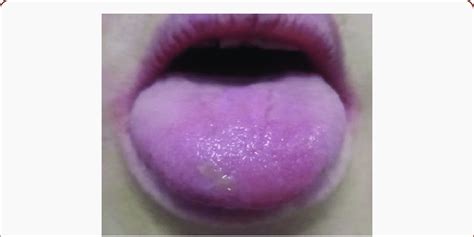 Blister On The Tongue In Pemphigus Vulgaris Download Scientific Diagram