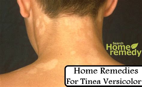 7 Best Home Remedies For Tinea Versicolor Search Home Remedy