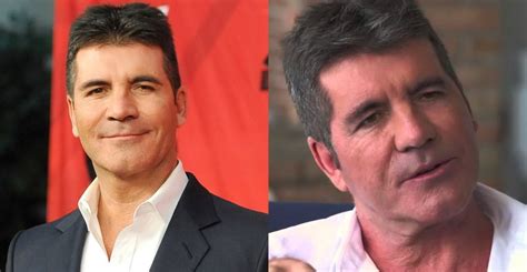 Simon Cowell Before And After Plastic Surgery 38 Celebrity Plastic