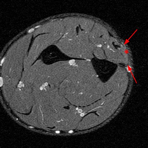 Muscle Herniation Radsource