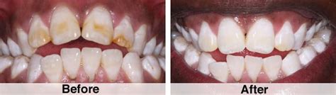 Fluorosis And Microabrasion Kawana Dental Sunshine Coast