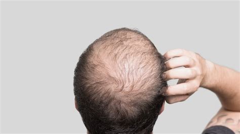 What Is Male Pattern Baldness And What Can You Do About It