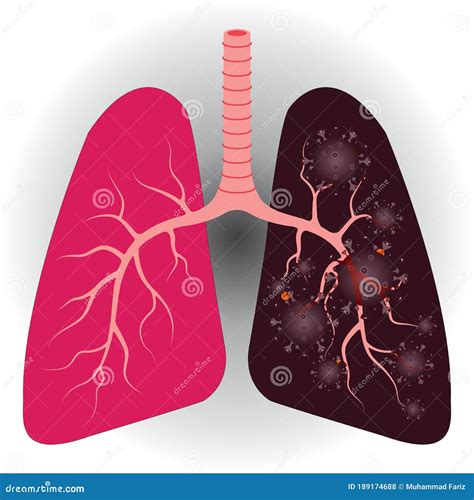 Compare Between Normal Healthy Lung And Coronavirus Lung Damage Vector
