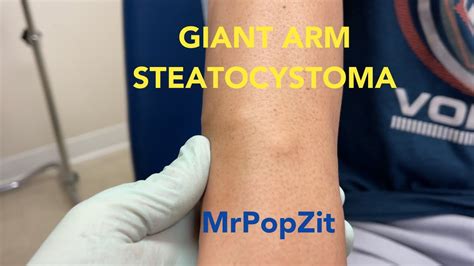 Large Steatocystoma On Forearm Popped Sac Removal And Closure With