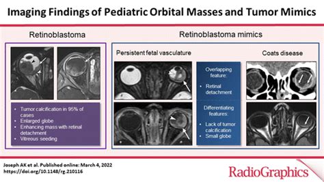 Imaging Findings Of Pediatric Orbital Masses And Tumor Mimics