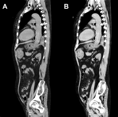 Cureus Aortic Dissection Due To Eosinophilic