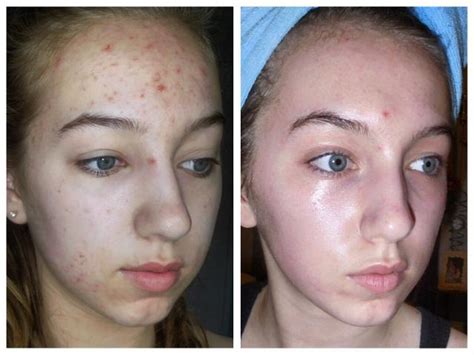 Walmart.com has been visited by 1m+ users in the past month Epiduo - Pictures & Videos - Acne.org Community