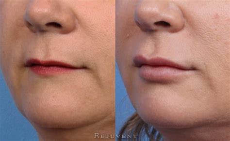 Fuller And More Defined Lip After Lip Fillers At Rejuvent Lip Enhancement Lips Medical Spa