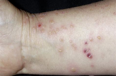 Vasculitis Photograph By Dr P Marazziscience Photo Library