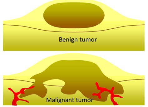 Difference Between Malignant And Benign Tumor Biomada