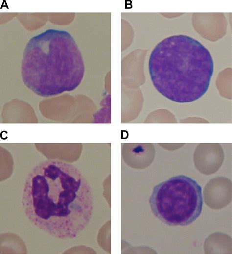 Acute Lymphoblastic Leukemia Detection And Classification Of Its