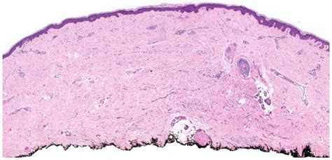 Dermatopathology Free Full Text Histopathological Variants Of