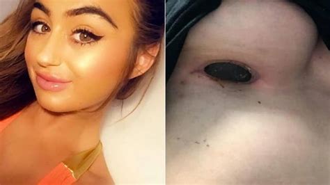 Woman Claims Implant Scar Smelled Like Rotten Meat Latest News Videos Fox News