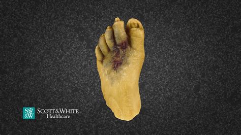 Left Foot With Diabetic Ulcers And Necrosis 3d Model By Scott And White