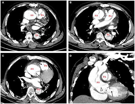 Frontiers Case Report Simultaneous Ascending Aortic Dissection And