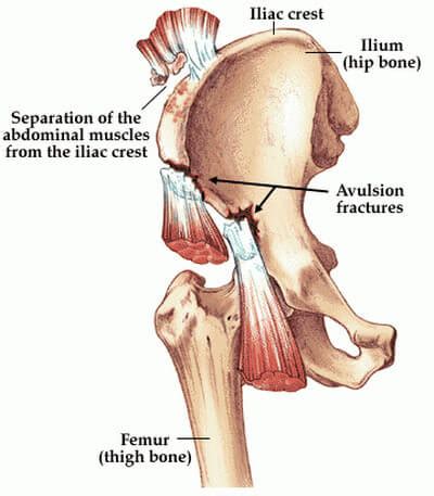 Causes Of Pain Over The Iliac Crest Picture E Medical Hub