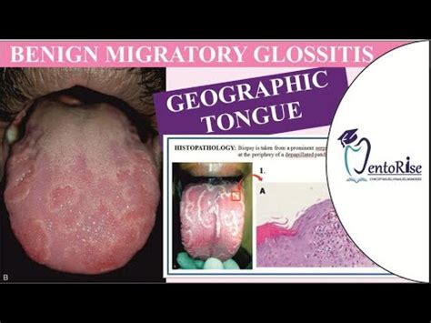 Benign Migratory Glossitis Geographic Tongue Developmental Disturbance Of Tongue Oral