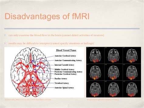 Mri Presentation Final