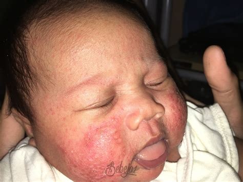 Mayang 40 Cradle Cap Eczema Rash On Baby Face