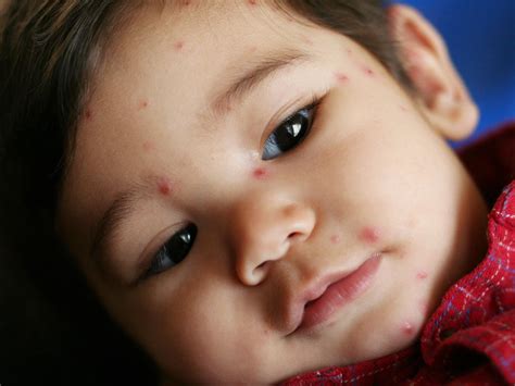 Visual Guide To Childrens Rashes And Skin Conditions Photo Gallery