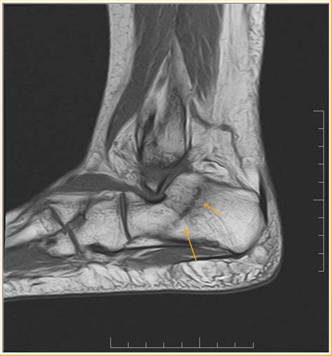 Calcaneal Stress Fracture Sumers Radiology Blog