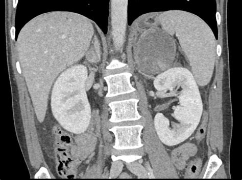 Primary Adrenal Carcinoma With Hemorrhage Adrenal Case Studies