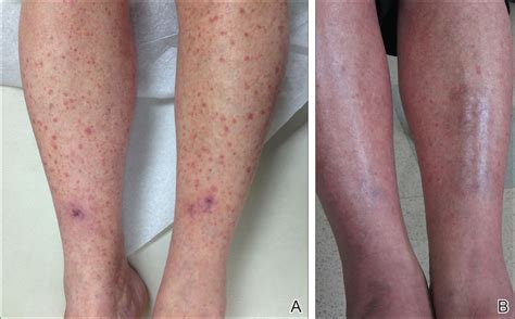 Allergic Vasculitis Pictures