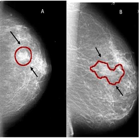 Breast Cancer Detection Using Deep Convolutional Neural Networks And