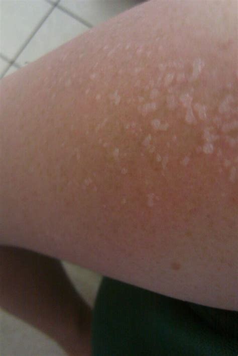 White Spots On Skin After Tanning