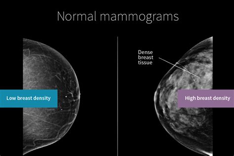 Mammogrambreastdensity Wellend Health