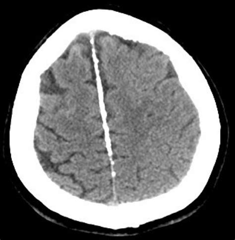 Unenhanced Brain Computed Tomography Scan Axial View Ectopic