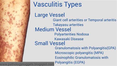 Approach To Types Of Vasculitis Easy Review Notes Of Large Medium Small Vessel And Other