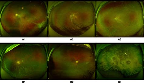 Ultra Widefield Fundus Images Showing Typical Misclassified Cases In
