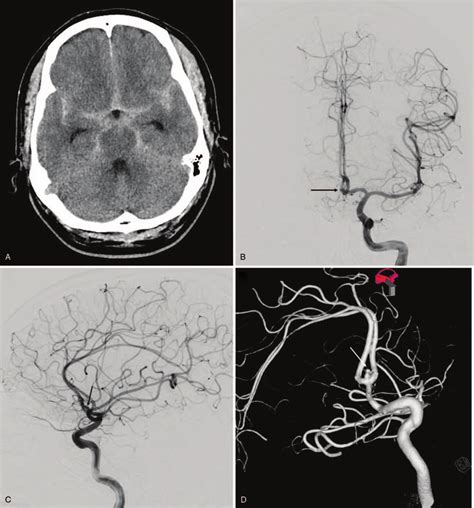 A Axial View Of Non Enhanced Computed Tomography Showing Subarachnoid