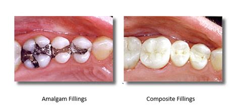 Dentist Messed Up My White Fillings The Blog Of Sherwood Dental Care