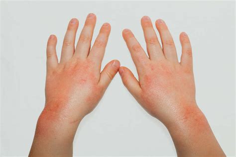 Rimedi Naturali Dermatite Da Freddo Non Sprecare