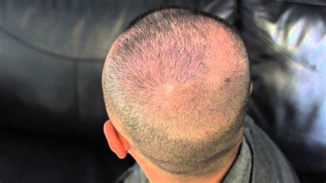 Because the clinic encourages appointments, there is usually time to screen patient _ their eligibility. Scalp Micropigmentation Los Angeles - Marc treated at HIS ...