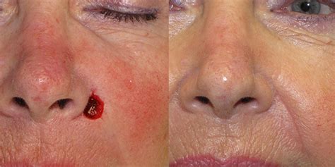 Island Flap 2 Before After Skin Cancer And Reconstructive Surgery