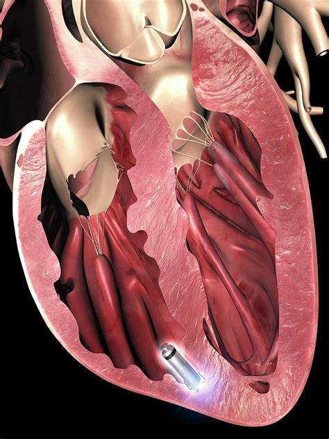 Leadless Pacemaker In Anterior Heart Photograph By Alfred Pasieka