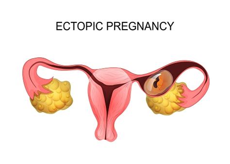 Ectopic Pregnancy Apollo Cradle