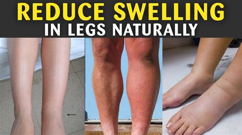 How To Reduce Swelling In Legs Home Remedies For Swollen Feet Youtube
