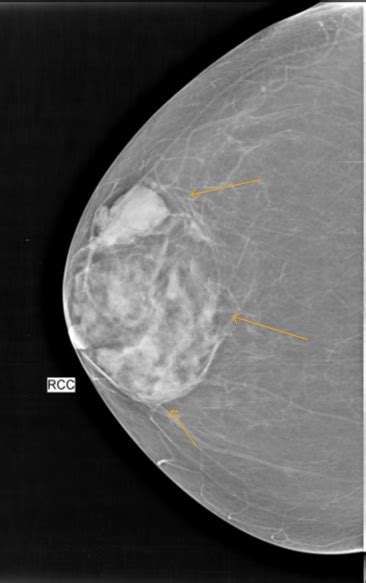 Breast Hamartoma Mammogram Sumer S Radiology Blog