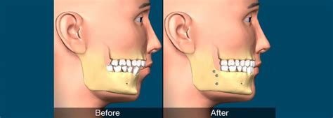 Orthognathic Surgery Jaw Surgery Corrective Dr Thomas George