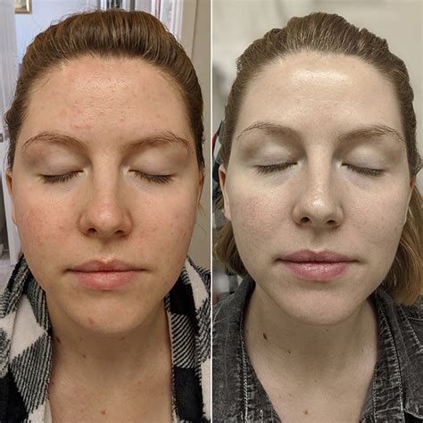 Before And After A Korean Routine For Sensitive Acne Prone Skin
