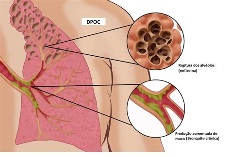 é Definida Genericamente Como Inflamação Do Parênquima Pulmonar